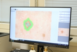 Nový digitální dermatoskop k diagnostice znamének